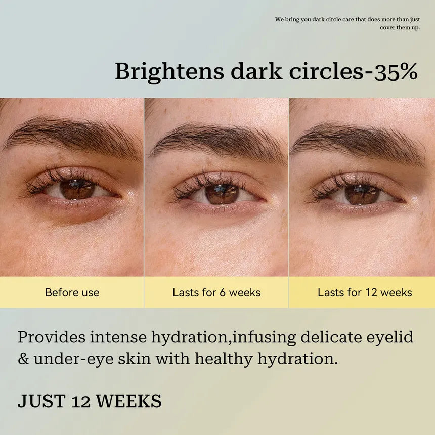 Bye Bye Dark Circles